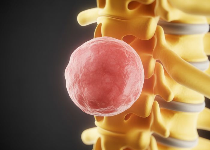 Illustration of a lipoma located on the spine. A lipoma is a benign fatty tumor that can sometimes occur in the spinal region.